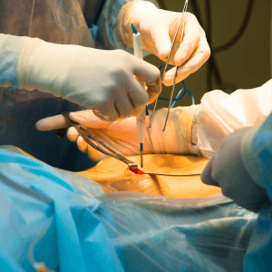 Services 7 Laparoscopy Hysterectomy
